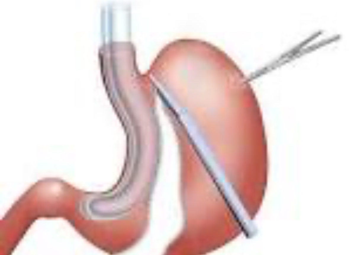 شرح مبسط لعملية التكميم